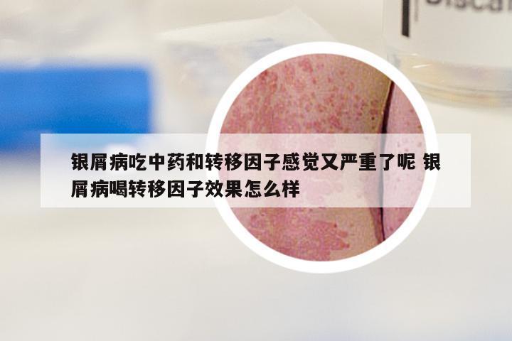 银屑病吃中药和转移因子感觉又严重了呢 银屑病喝转移因子效果怎么样