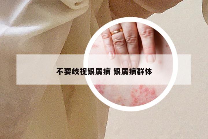不要歧视银屑病 银屑病群体