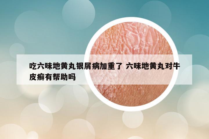 吃六味地黄丸银屑病加重了 六味地黄丸对牛皮癣有帮助吗