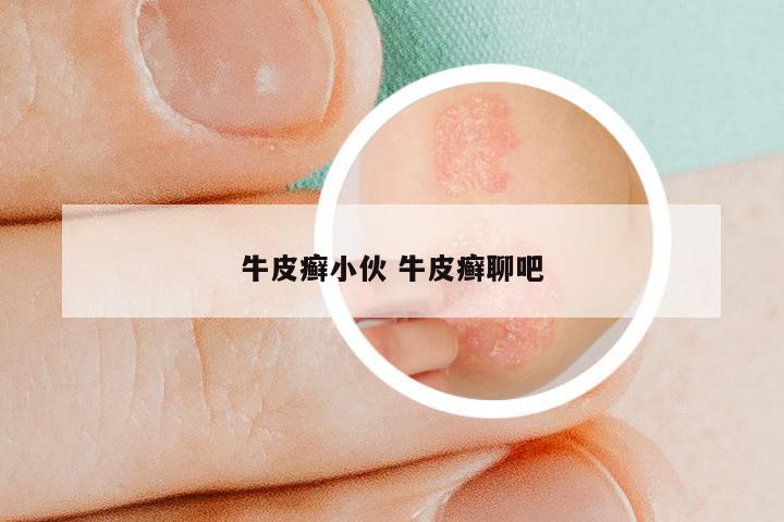 牛皮癣小伙 牛皮癣聊吧