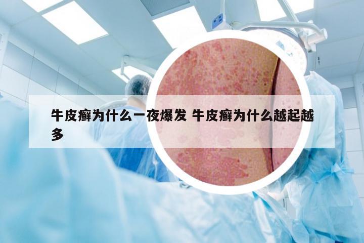 牛皮癣为什么一夜爆发 牛皮癣为什么越起越多