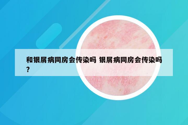 和银屑病同房会传染吗 银屑病同房会传染吗?