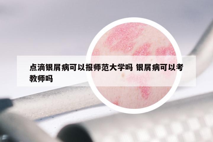 点滴银屑病可以报师范大学吗 银屑病可以考教师吗