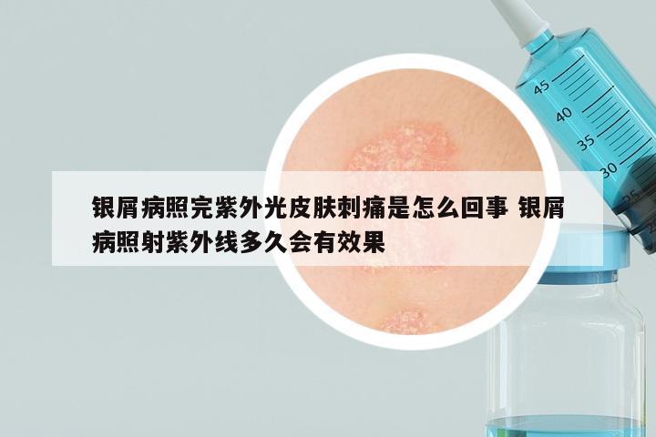 银屑病照完紫外光皮肤刺痛是怎么回事 银屑病照射紫外线多久会有效果