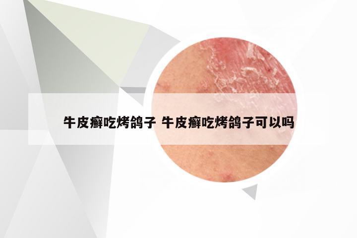 牛皮癣吃烤鸽子 牛皮癣吃烤鸽子可以吗