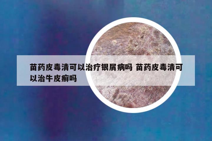 苗药皮毒清可以治疗银屑病吗 苗药皮毒清可以治牛皮癣吗