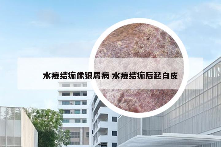 水痘结痂像银屑病 水痘结痂后起白皮
