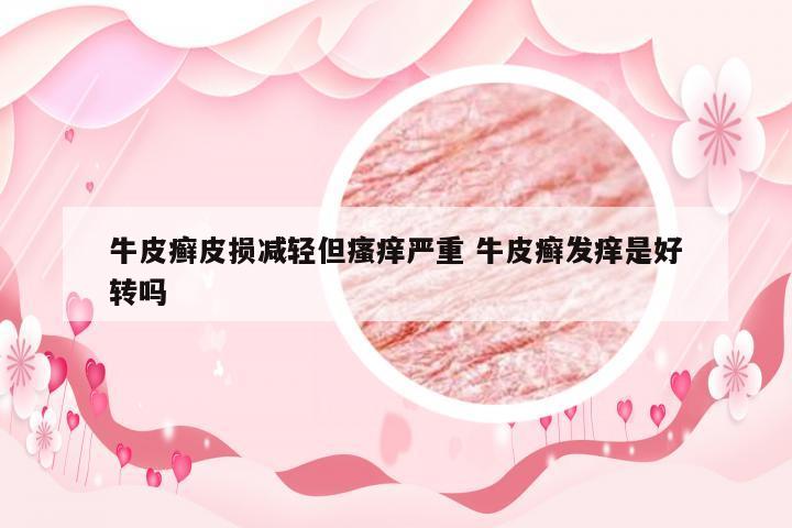 牛皮癣皮损减轻但瘙痒严重 牛皮癣发痒是好转吗