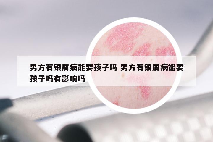 男方有银屑病能要孩子吗 男方有银屑病能要孩子吗有影响吗