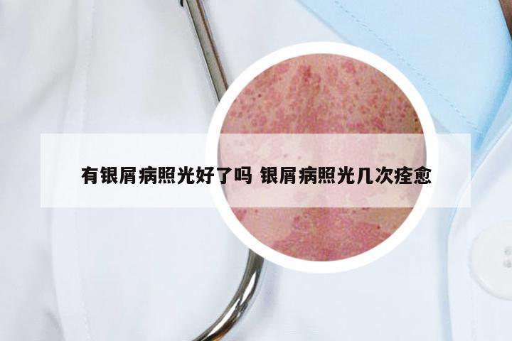 有银屑病照光好了吗 银屑病照光几次痊愈