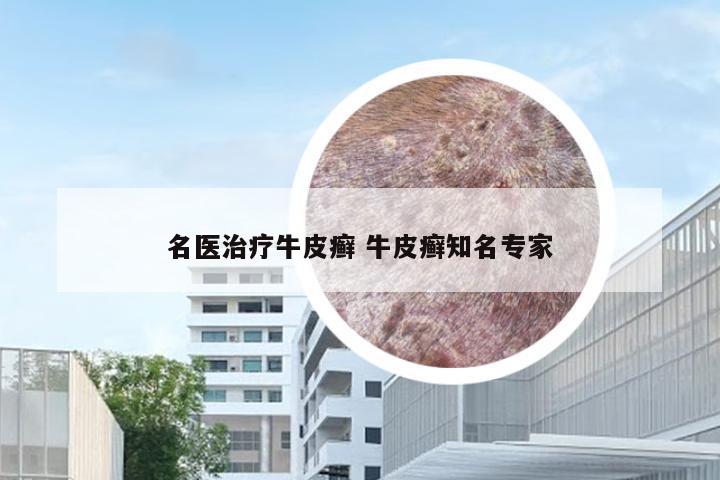 名医治疗牛皮癣 牛皮癣知名专家