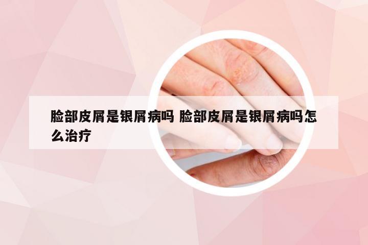 脸部皮屑是银屑病吗 脸部皮屑是银屑病吗怎么治疗