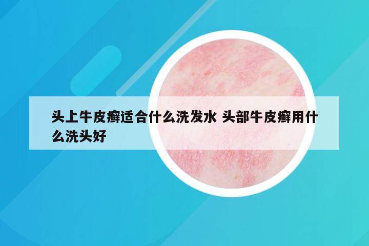头上牛皮癣适合什么洗发水 头部牛皮癣用什么洗头好