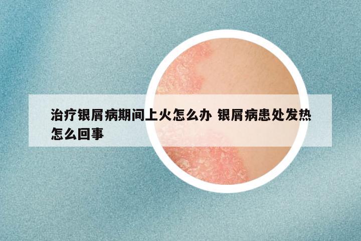 治疗银屑病期间上火怎么办 银屑病患处发热怎么回事