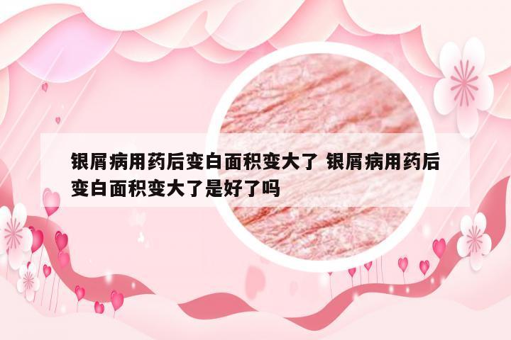 银屑病用药后变白面积变大了 银屑病用药后变白面积变大了是好了吗