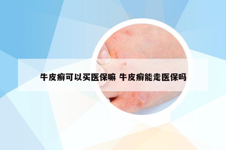 牛皮癣可以买医保嘛 牛皮癣能走医保吗