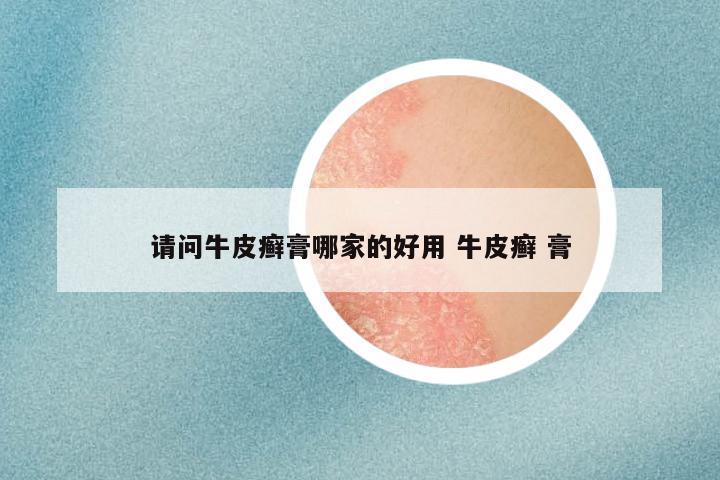 请问牛皮癣膏哪家的好用 牛皮癣 膏