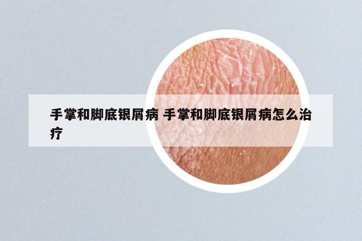 手掌和脚底银屑病 手掌和脚底银屑病怎么治疗