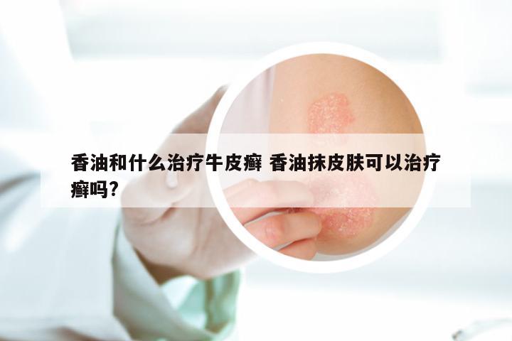 香油和什么治疗牛皮癣 香油抹皮肤可以治疗癣吗?