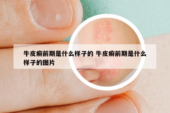牛皮癣前期是什么样子的 牛皮癣前期是什么样子的图片