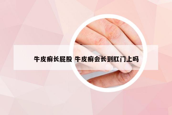 牛皮癣长屁股 牛皮癣会长到肛门上吗