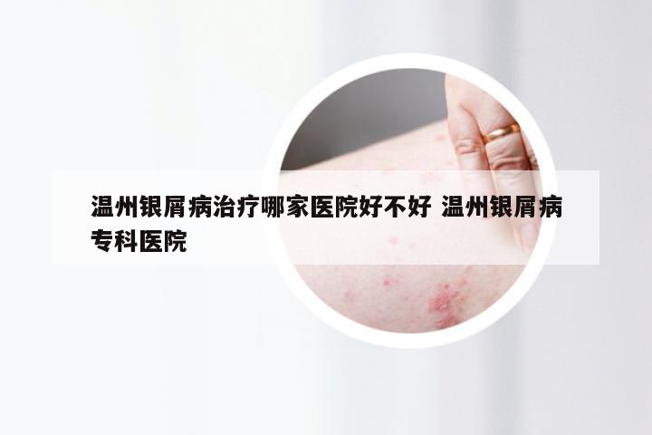 温州银屑病治疗哪家医院好不好 温州银屑病专科医院