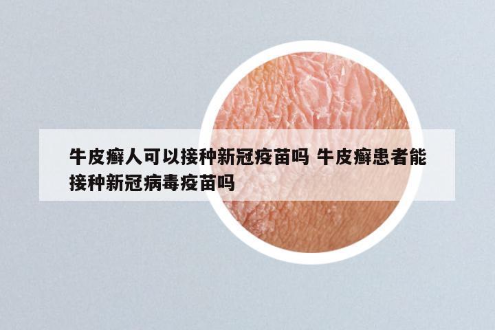 牛皮癣人可以接种新冠疫苗吗 牛皮癣患者能接种新冠病毒疫苗吗
