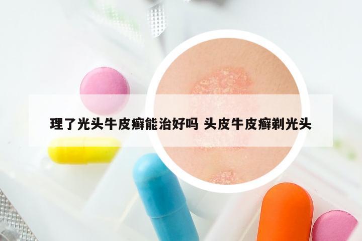 理了光头牛皮癣能治好吗 头皮牛皮癣剃光头