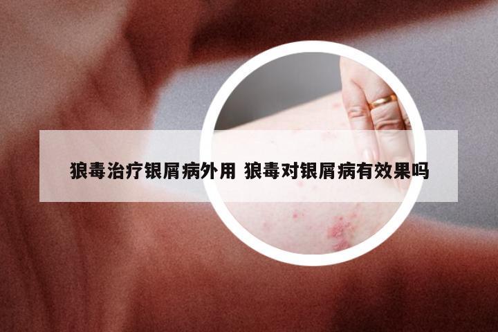 狼毒治疗银屑病外用 狼毒对银屑病有效果吗