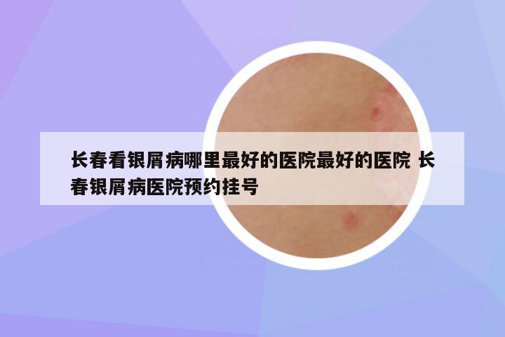 长春看银屑病哪里最好的医院最好的医院 长春银屑病医院预约挂号