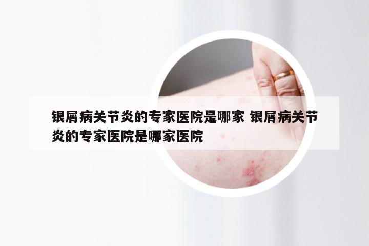 银屑病关节炎的专家医院是哪家 银屑病关节炎的专家医院是哪家医院