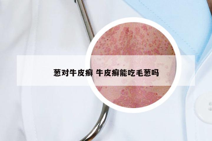 葱对牛皮癣 牛皮癣能吃毛葱吗