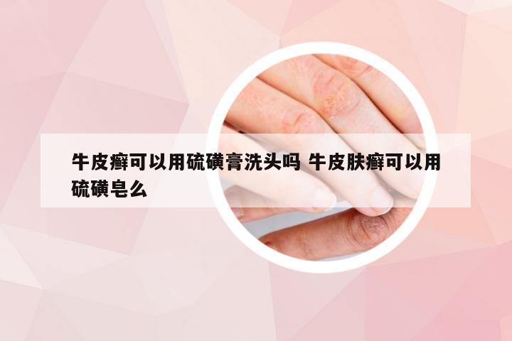 牛皮癣可以用硫磺膏洗头吗 牛皮肤癣可以用硫磺皂么
