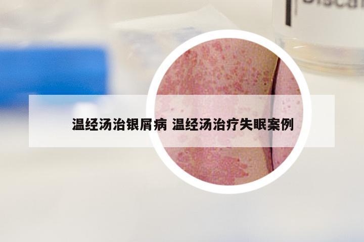 温经汤治银屑病 温经汤治疗失眠案例