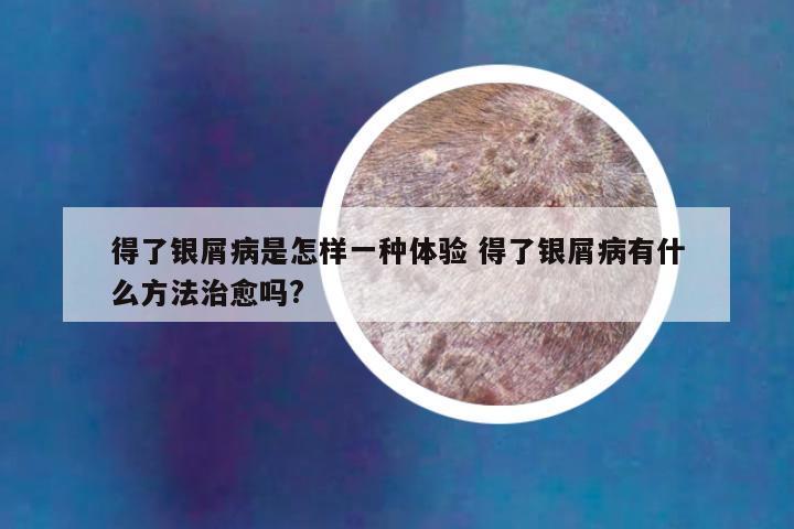 得了银屑病是怎样一种体验 得了银屑病有什么方法治愈吗?