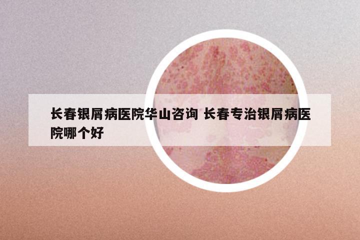 长春银屑病医院华山咨询 长春专治银屑病医院哪个好