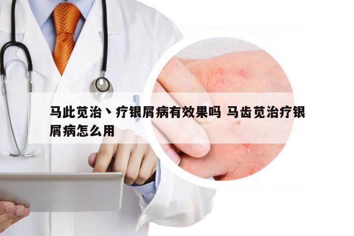 马此苋治丶疗银屑病有效果吗 马齿苋治疗银屑病怎么用