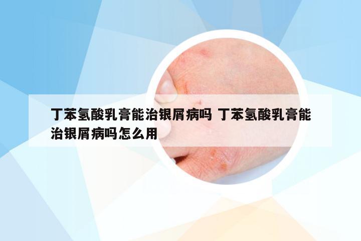 丁苯氢酸乳膏能治银屑病吗 丁苯氢酸乳膏能治银屑病吗怎么用
