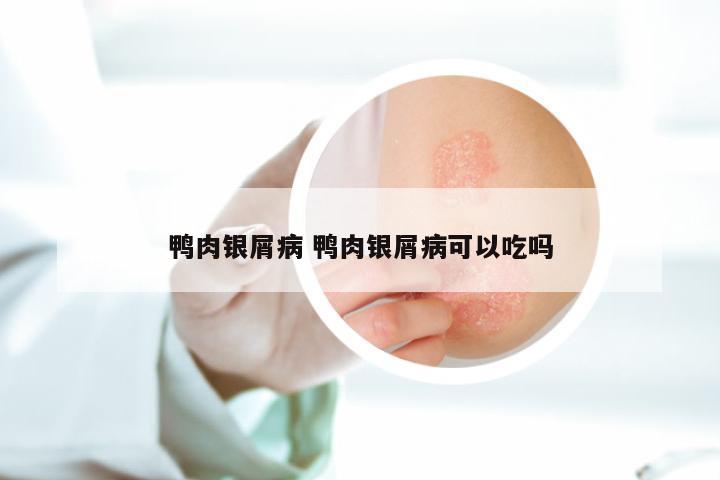 鸭肉银屑病 鸭肉银屑病可以吃吗