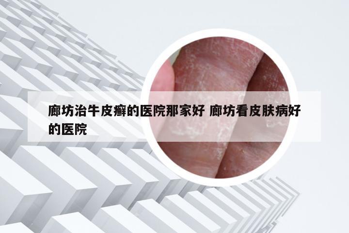 廊坊治牛皮癣的医院那家好 廊坊看皮肤病好的医院