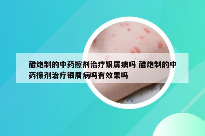 醋炮制的中药擦剂治疗银屑病吗 醋炮制的中药擦剂治疗银屑病吗有效果吗
