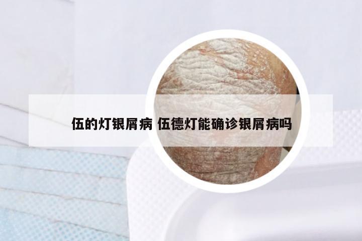 伍的灯银屑病 伍德灯能确诊银屑病吗