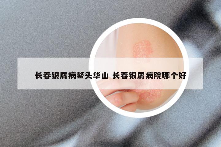 长春银屑病鳌头华山 长春银屑病院哪个好