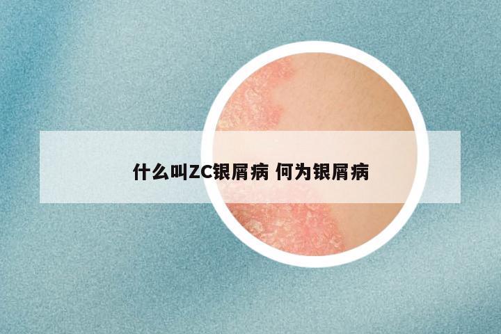 什么叫ZC银屑病 何为银屑病