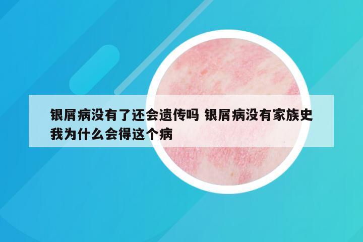 银屑病没有了还会遗传吗 银屑病没有家族史我为什么会得这个病