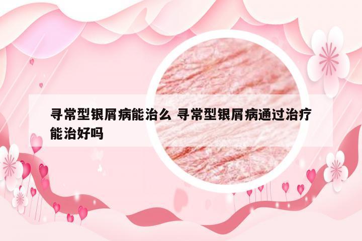 寻常型银屑病能治么 寻常型银屑病通过治疗能治好吗