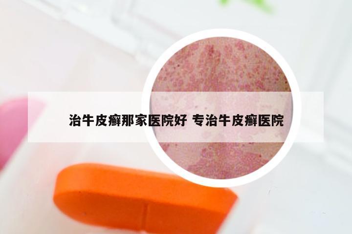治牛皮癣那家医院好 专治牛皮癣医院