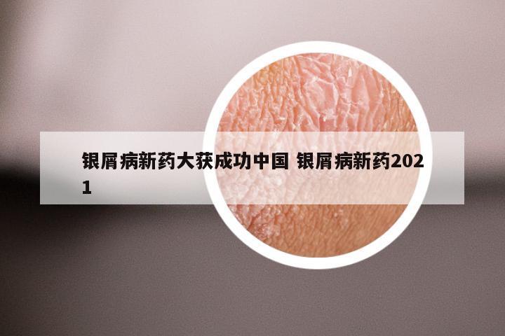银屑病新药大获成功中国 银屑病新药2021