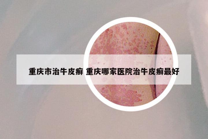 重庆市治牛皮癣 重庆哪家医院治牛皮癣最好