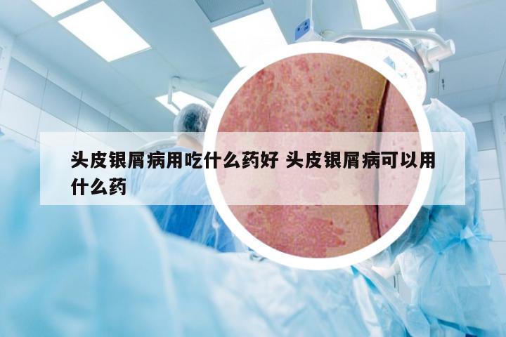 头皮银屑病用吃什么药好 头皮银屑病可以用什么药